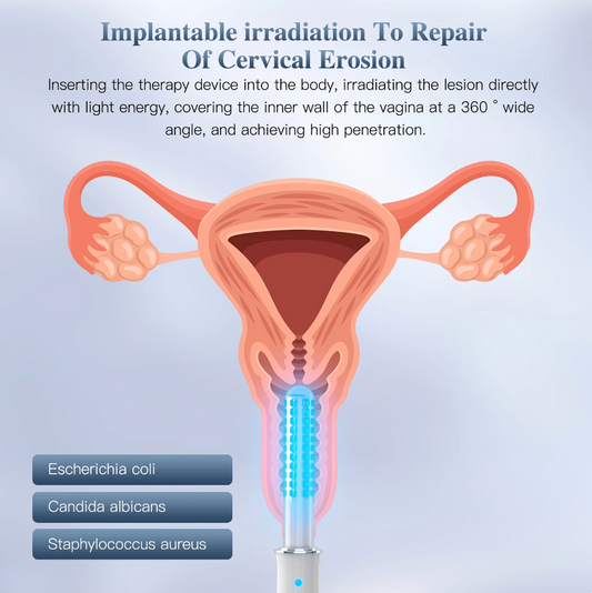 ワイヤレス膣バイブレーター,LED療法マッサージ,女性の腱炎,膣引き締め