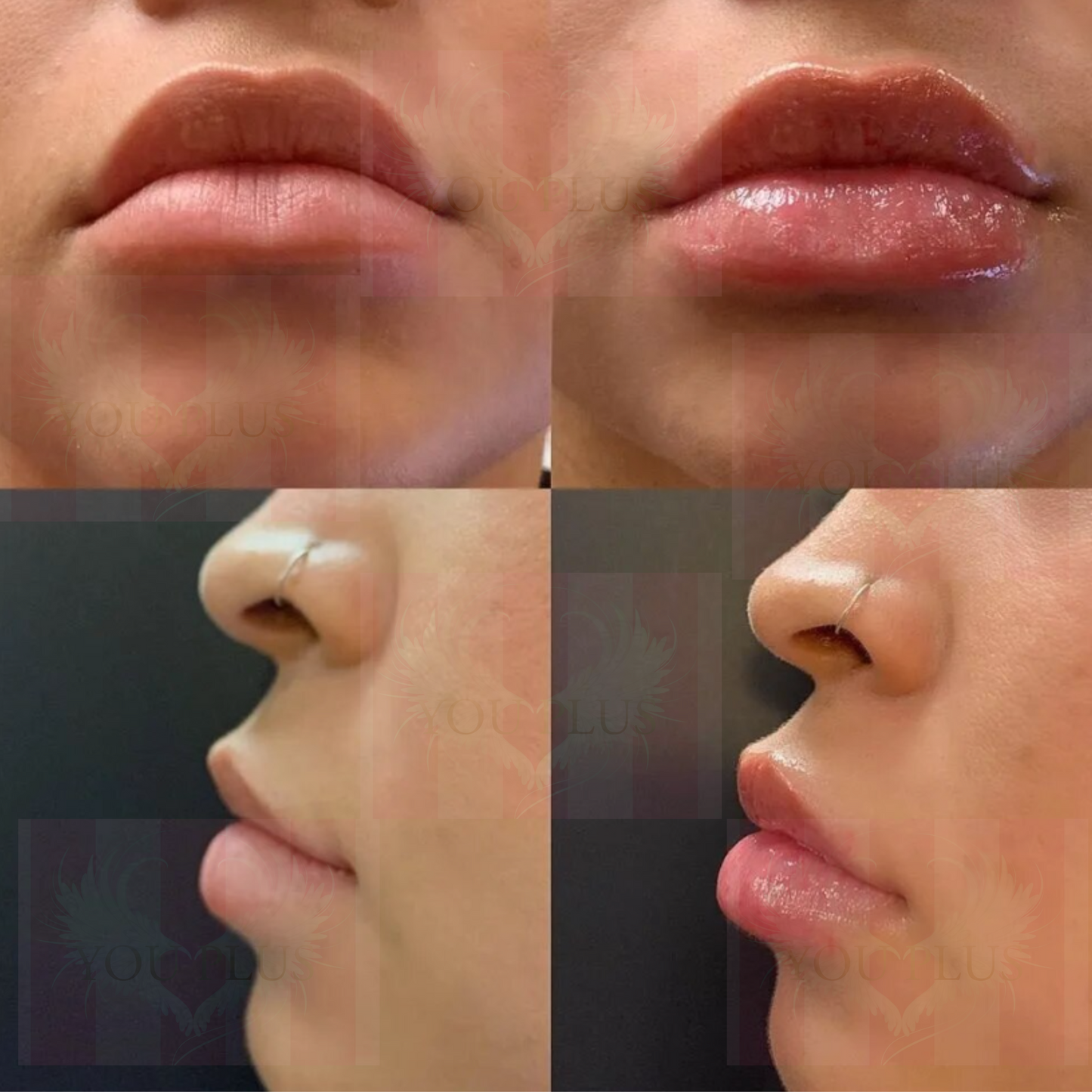 Korean Lip Hyaluronic Acid Crosslinked HA Enhancement Makeup Whitening Cosmetic lip enlargement