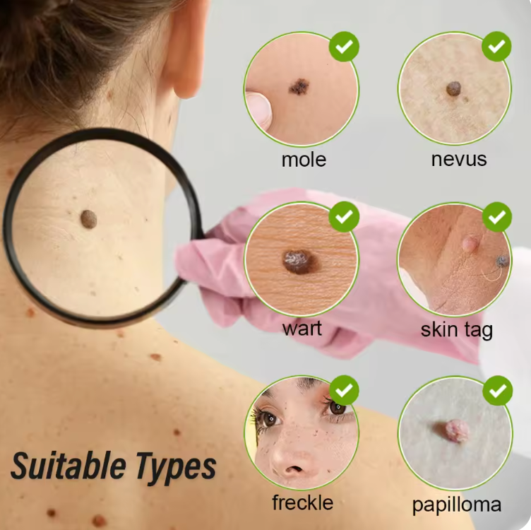 Skin Tag Remover Laser Plasma Pen Dark Spot Mole Wart Remover Pen Electric Tattoo Freckle Nevus Black Spots Skin Tag Removal