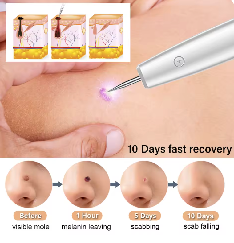 Skin Tag Remover Laser Plasma Pen Dark Spot Mole Wart Remover Pen Electric Tattoo Freckle Nevus Black Spots Skin Tag Removal