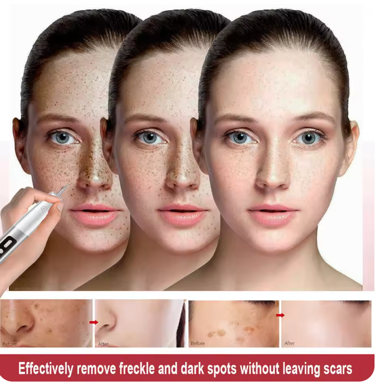 Skin Tag Remover Laser Plasma Pen Dark Spot Mole Wart Remover Pen Electric Tattoo Freckle Nevus Black Spots Skin Tag Removal