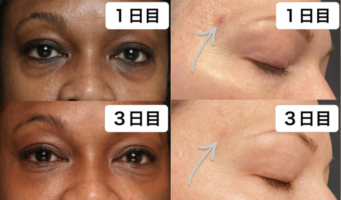 Ombra ニキビレーザー(Acne Lazer)