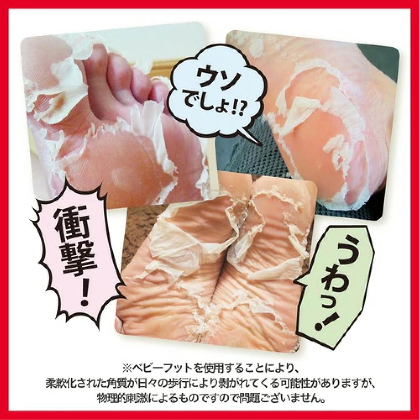 Baby Foot Easy Pack, 60-Minute Type, Medium, Hello Kitty Packaging, Heel Exfoliating, Foot Peeling (Up to 10.6 inches (27 cm)