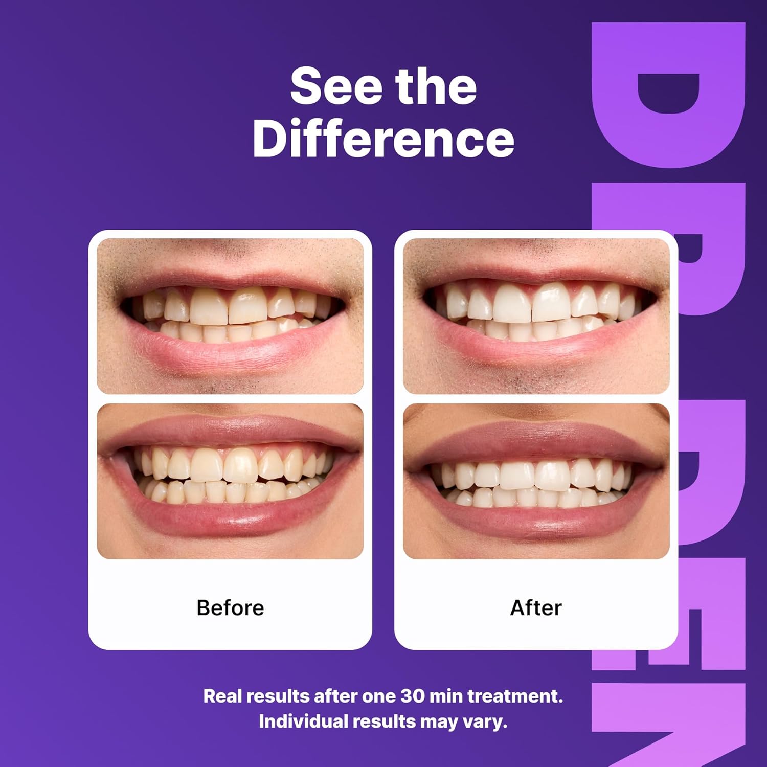 DRDENT Tiras blanqueadoras de dientes moradas, 21 tratamientos, seguras para esmalte, blanqueamiento dental no sensible, blanqueamiento sin ningún daño, paquete de 42 tiras