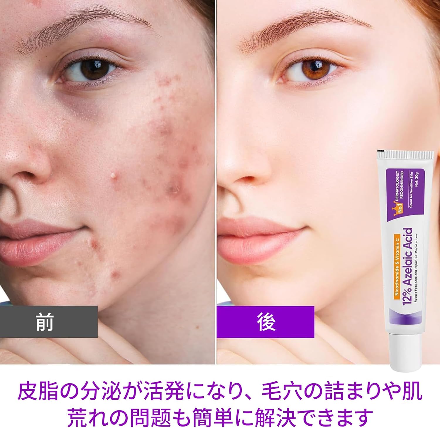 [Popular] Snail Extract Cream, Moisturizing, Facial for Women, Hyaluronic Acid and Snail Extract Formulated (Azelaic Acid Cream, 0.7 oz (20 g)