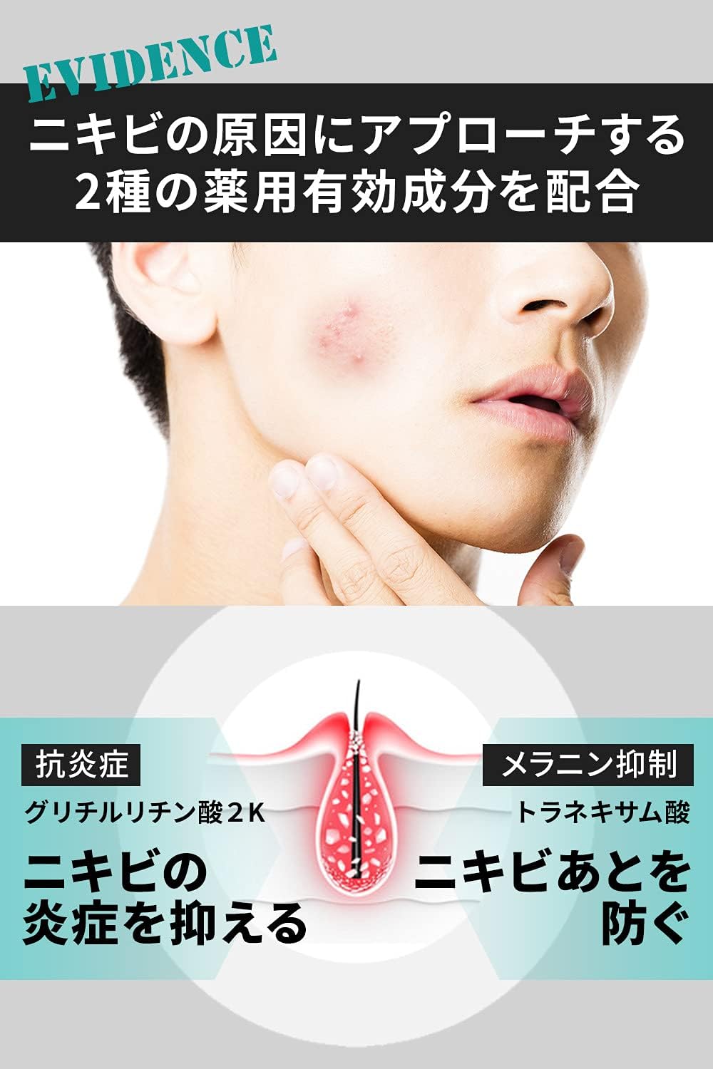 Acne Care Cream, Medicinal Use, All-in-One, Large Volume: 3.5 oz. (100 g), Adult Acne, Back, Acne Care, Rough Skin, Moisturizing, For Men, Face, Full Body, Face Cream, All-in-One Gel Acne Cream, Acne Cream, Quasi-Drug