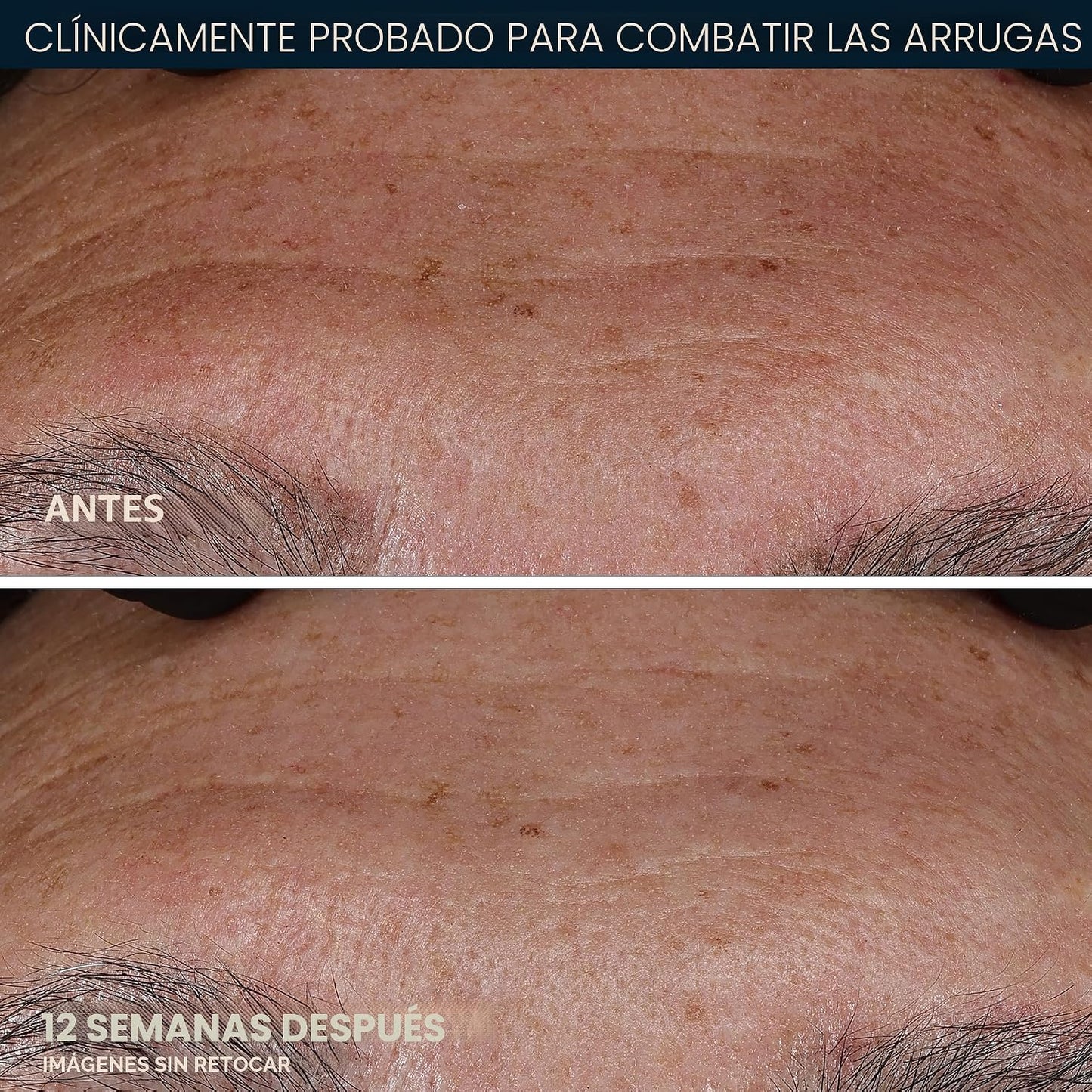 RoC Retinol Correxion Deep Wrinkle Retinol Face Serum con ácido ascórbico, tratamiento diario antienvejecimiento para líneas finas, manchas oscuras, cicatrices de acné, 1 onza (el embalaje puede