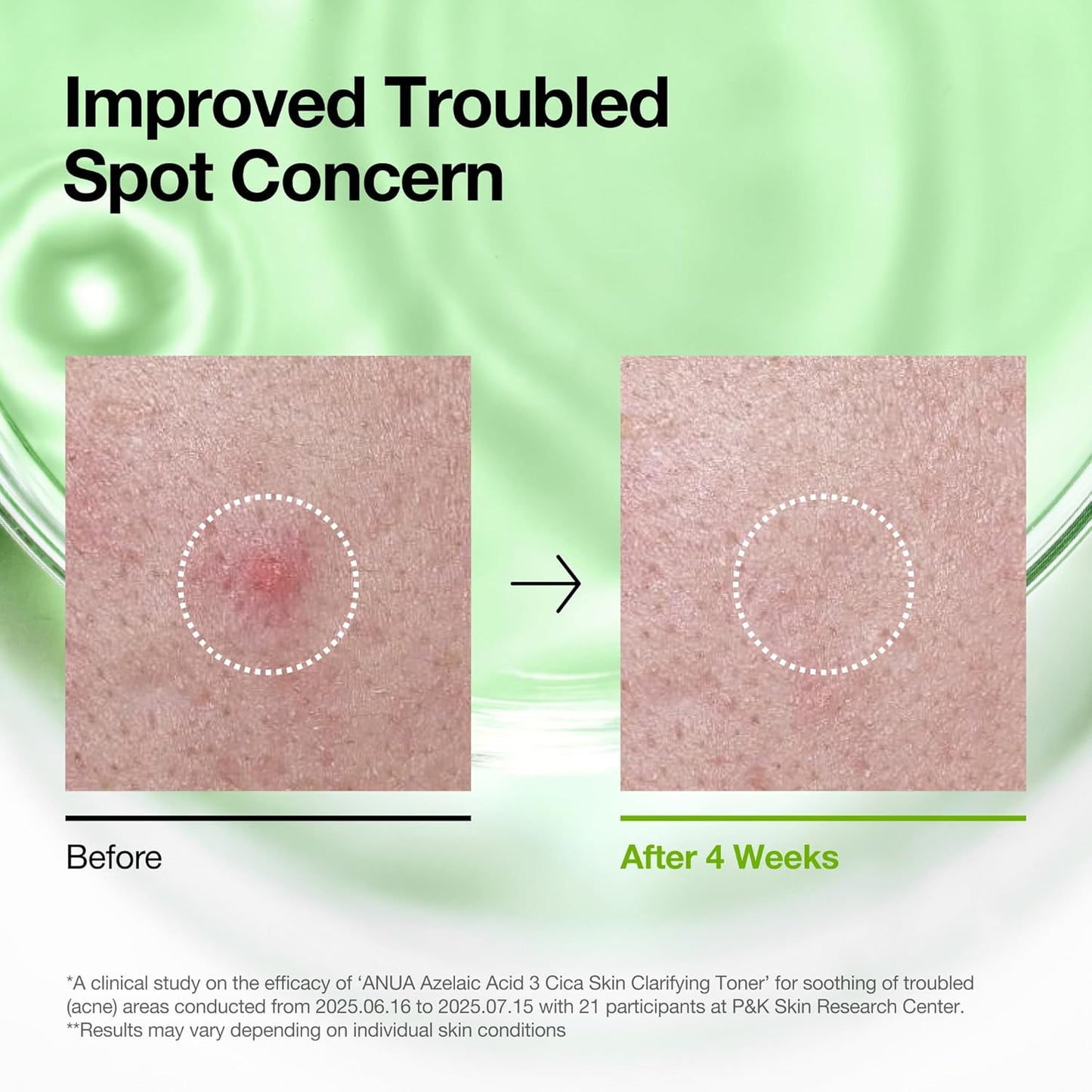 Anua Tónico aclarante de ácido azelaico 3 CICA, tónico facial exfoliante diario con salicílico, para calmar y claridad de la piel, cuidado de sebo y manchas, adecuado para pieles sensibles, cuidado de la piel coreano, 8.45 onzas líquidas